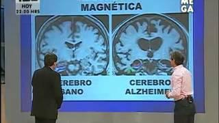 Cómo identificar si padeces Alzheimer