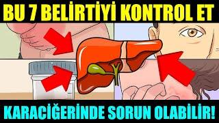 BU 7 BELİRTİ KARACİĞERİNİZDE SORUN OLDUĞUNU GÖSTERİR; İHMAL ETMEYİN! #şifabul #karaciğer