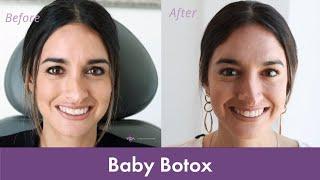 Baby Botox Experience | Getting Botox for the First Time!