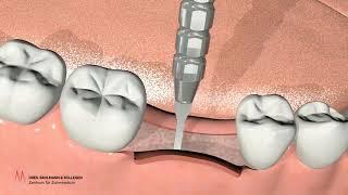 Zahnimplantat Köln - Erklärvideo, welche Schritte sind erforderlich?