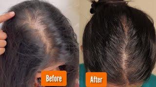 Best AYURVEDIC HERBS For Hair REGROWTH | Hair Growth Herbs | Shinny Roops