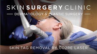 Skin Tag Removal by CO2RE Laser | Watch the Procedure