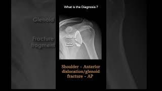 Shoulder Anterior dislocation/glenoid fracture AP 109 Trauma XrayUpperlimbG1#@radiologychannel007