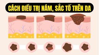 CÁCH ĐIỀU TRỊ NÁM, SẮC TỐ TRÊN DA | Bác sĩ Trường