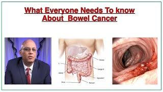 What Everyone Needs To Know About Bowel Cancer. Dr Espinet Teaching