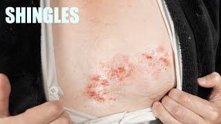 I HAVE SHINGLES