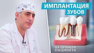 Имплантация зубов на реальном клиническом примере