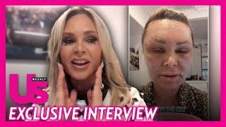 Tamra Judge Reacts to Molly Sims' Critique of Her Chemical Peel Treatment