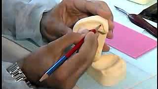 Complete Denture Procedure ; 03 Final Impression Trays