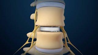 Back Surgery: Lumbar Disc Replacement