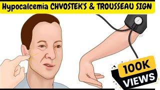 Hypocalcemia (Signs and Symptoms) - CHVOSTEK'S & TROUSSEAU SIGN.