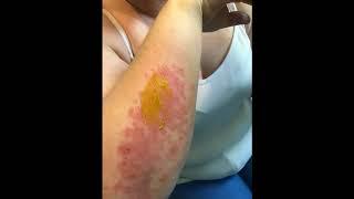 Psoriasis Cream Drug and Steroid Free