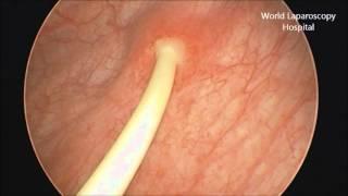 Removal of Double J stent by Cystoscopy