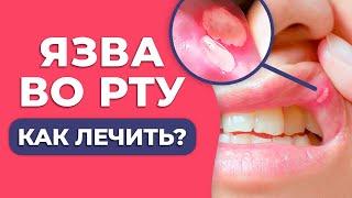 Как вылечить ЯЗВУ ВО РТУ? / Афта: причины появления