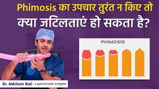 Phimosis Complications In Hindi || Live Demo on Tight Foreskin Treatment || Dr Abhilash Nali