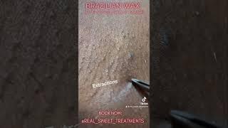 Brazilian Wax with HydroJelly treatment. #brazilianwax #getwaxed #waxing