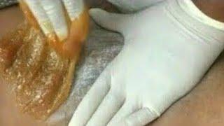 BRAZILIAN BIKINI LINE SUGARING SUGAR WAXING#wax #waxing #brazilian #sugaring #sugarwaxing #viral