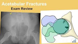 Acetabular Fractures Exam Review - Ben Taylor, MD