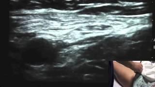 Ultrasound Guided Femoral Nerve Block - SSRAUSA.com