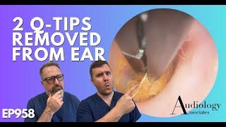 2 Q-TIPS REMOVED FROM EAR - EP958