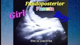 Fundoposterior placenta means baby boy/girl | Cord around the baby neck | 23 week scan | genderscan