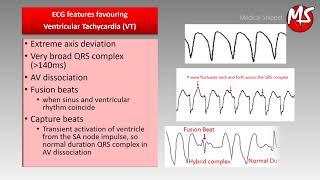 VT (Ventricular Tachycardia) vs SVT (Supraventricular tachycardia) with aberrancy