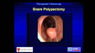 Therapeutic Colonoscopy: Polypectomy and Bleeding