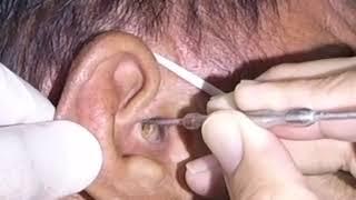 Massive Earwax Removed from Man and Woman's Ear