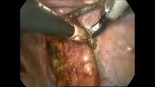 Sciatic nerve schwannoma in the pelvis