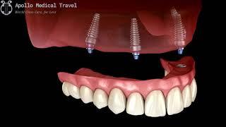 Animated Implant Supported Denture Procedure | Apollo Medical Travel