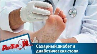 Сахарный диабет и диабетическая стопа | Доктор И