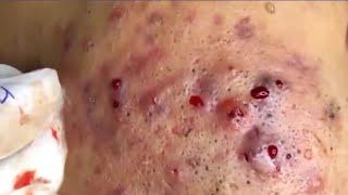 Purulent pimples and numerous blackheads on the face #disgust #beauty #dermatology #blackheads #acne