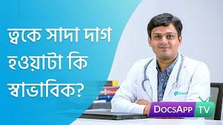 ত্বকে সাদা দাগ হওয়াটা কি স্বাভাবিক?  #AsktheDoctor