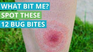 What Bit Me? Spot These 12 Bug Bites