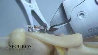 SECUROS University Tips & Tricks: Tensioning Device