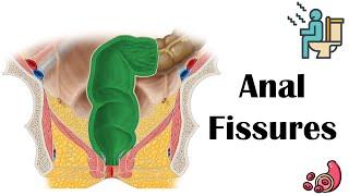 Anal Fissures - Causes, Risk Factors, Pathophysiology, Signs & Symptoms, Diagnosis, & Treatment