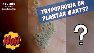 Trypophobia or plantar warts? #shorts