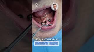 Dental cyberpunk. #имплантация #dentist