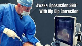 Awake Liposuction 360° With Hip Dip Correction. Dr. Alexey Markelov of AM Plastic Surgery.