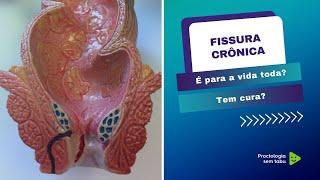 Fissura crônica é para vida toda? Como curar uma fissura crônica?