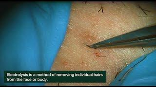 Electrolysis Ingrown Hair Removal | CLOSEUP | Here is how Electrolysis works! | Jade Clinics