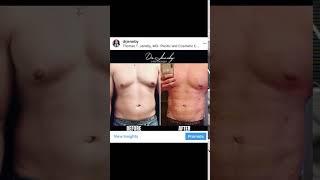 Before and after | Male breast Gynecomastia + Ab etching Before and after surgery |  Dr Jeneby