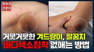 거뭇거뭇한 겨드랑이, 팔꿈치 색소침착에 대한 모든것! 이 영상으로 종결합니다! #색소침착 #바디색소침착