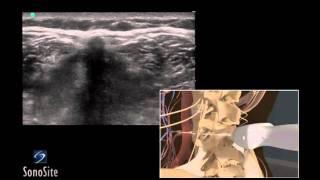 How To: Ultrasound Guided Lumbar Puncture Procedure 3D Video