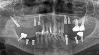 Using EZguide™ for Implants Placement Tuff and Pterygoids | Dr. Michael Abba, Maxillofacial Surgeon