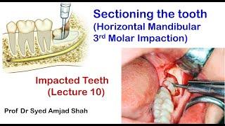 Sectioning / Cutting the tooth (Horizontal Mandibular Third Molar Impaction) | Syed Amjad Shah