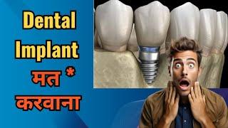 Say no to dental implant,if you have these conditions.