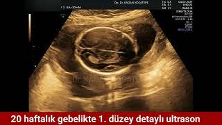 Detaylı ultrasonda bebeğin tepeden tırnağa organ taraması ve renkli Doppler nasıl yapılır? 1. düzey