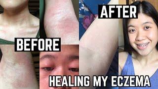 MY ECZEMA HEALING JOURNEY | NO MORE FLARE UPS IN JUST ONE WEEK