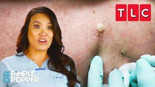 The BEST Blackhead Pops | Dr. Pimple Popper | TLC